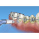 Pontas/Recargas Ortodônticas Waterpik (Compatíveis)